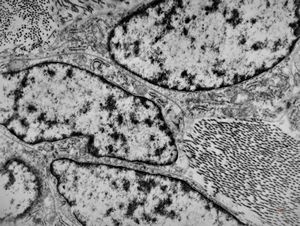 M,50y. | fibrous tumor - pleura M,50y. | fibrous tumor - pleura